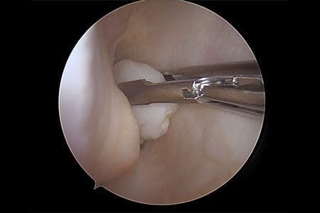 Arthroscopy