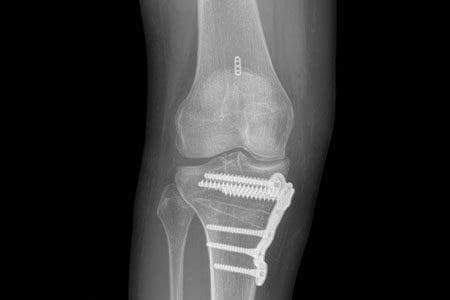 High tibial osteotomy
