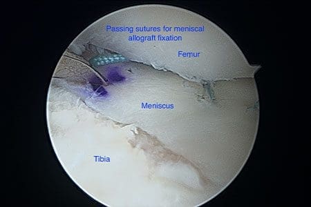 Meniscal allograft