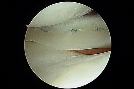 Meniscus repair