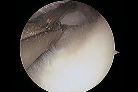 Meniscus surgery