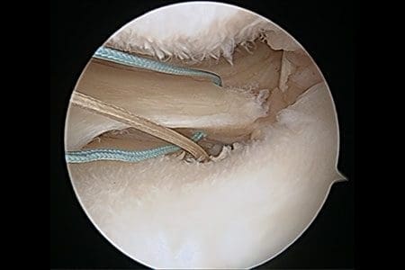 Root repair