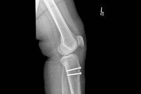 Tibial tubercle osteotomy